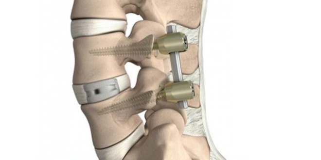Intervenţii chirurgicale de stabilizare de coloană vertebrală realizate în premieră la Spitalul Judeţean de Urgenţă din Miercurea Ciuc