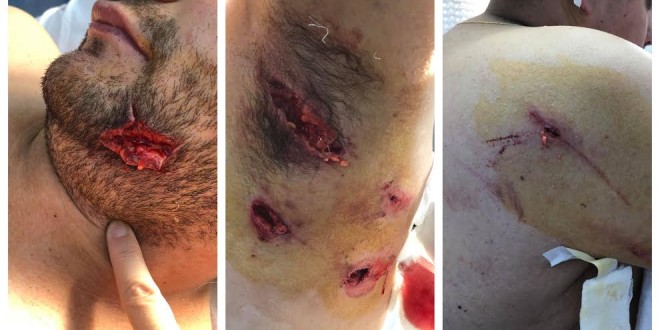 Ursul a atacat din nou la Băile Tuşnad – două persoane spitalizate